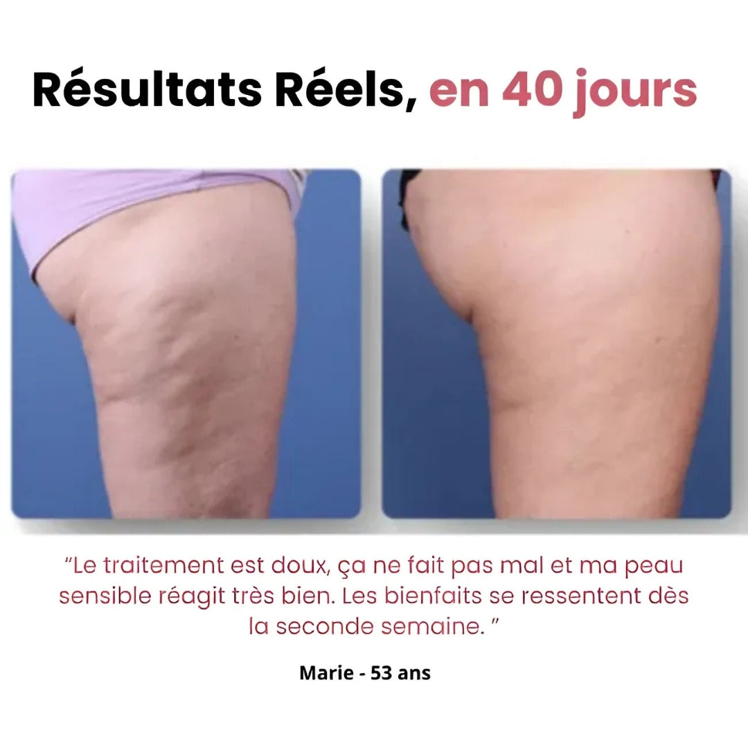 DermoLift™ - Masseur Anti-Cellulite