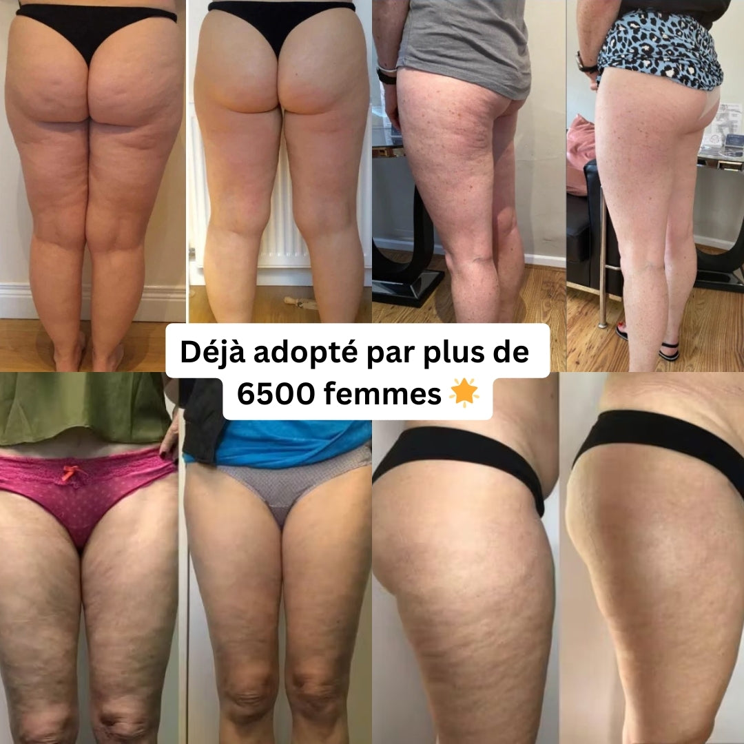 DermoLift™ - Masseur Anti-Cellulite
